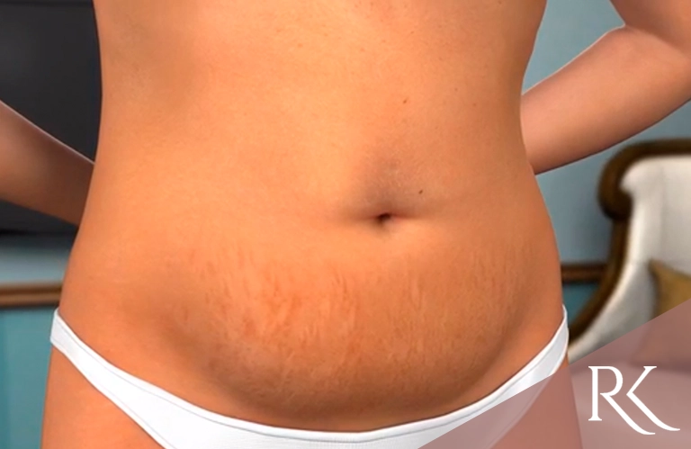 Abdominoplastia