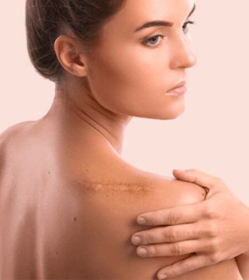 correção de cicatrizes